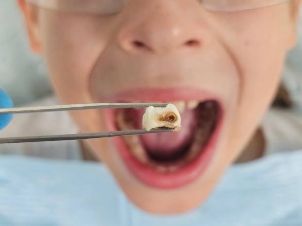 Best Emergency Root Canal Treatment in Richwood, OH